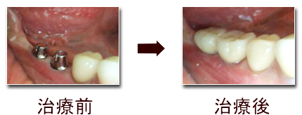 左奥歯の治療