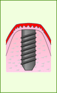 人工歯根の植え込み
